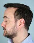 After Hair Transplant&nbsp;Front